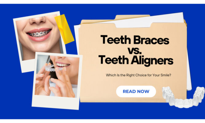 Teeth Braces vs. Teeth Aligners: Which Is the Right Choice for Your ...