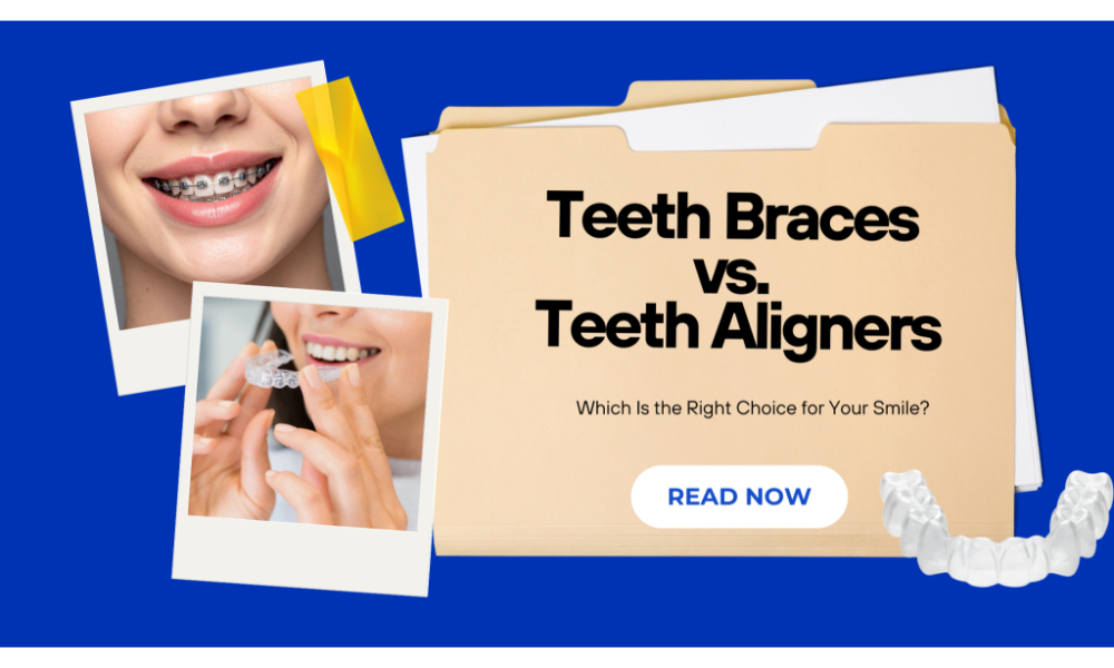 Teeth Braces vs. Teeth Aligners: Which Is the Right Choice for Your ...